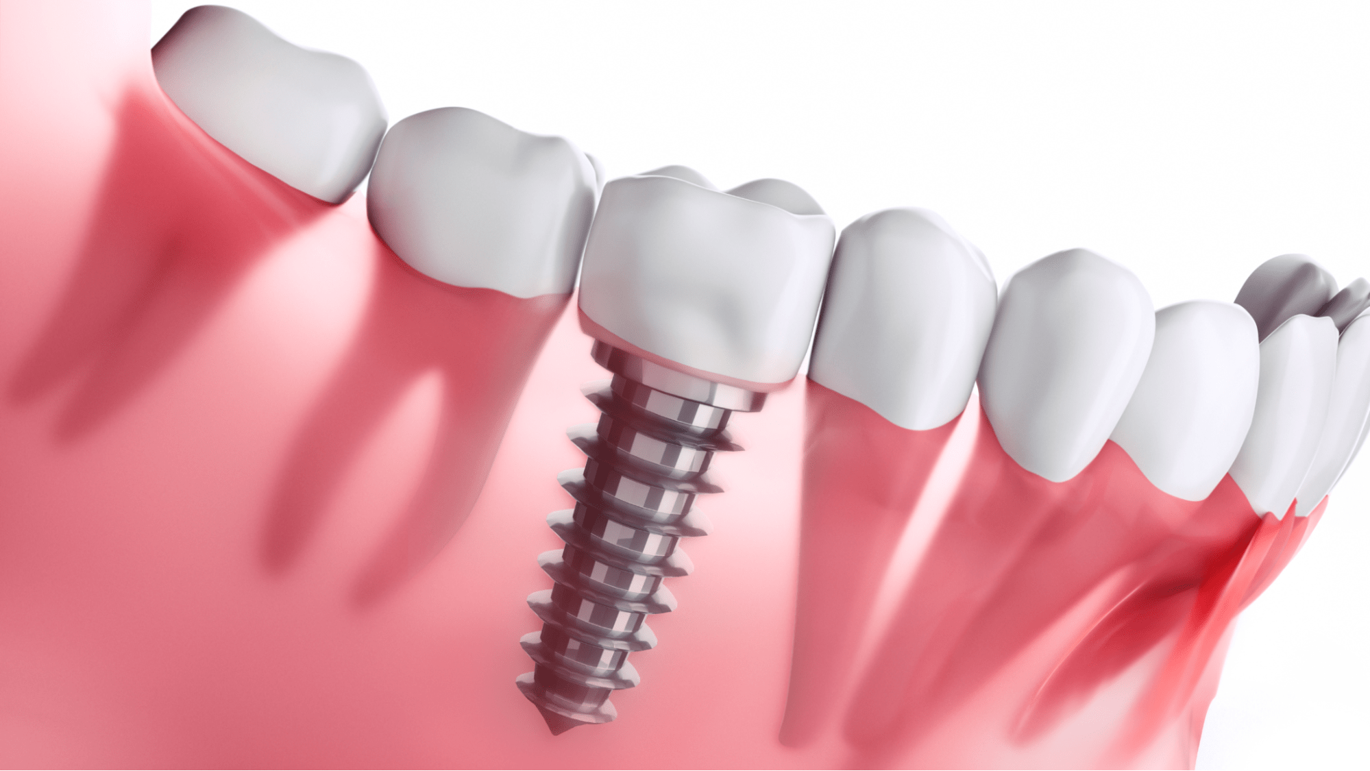 What are the best dental implants and which type would be the one for you?